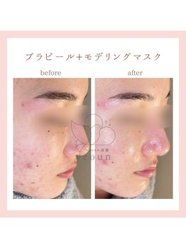 ヨウン 大阪心斎橋(yeoun)/プラピール/プラピール大阪