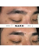 ナークス(NARX)/【眉毛脱毛】ビフォーアフター
