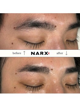 ナークス(NARX)/【眉毛脱毛】ビフォーアフター