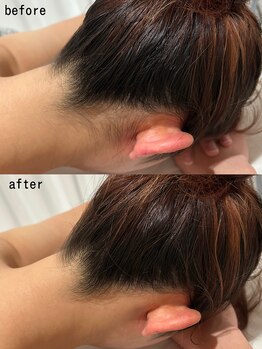 スパ ナナプラス(SPA nana+)/全身脱毛