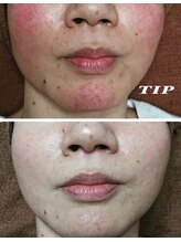 プランス 福岡(PLANCE)/剥けないハーブピーリングエステ