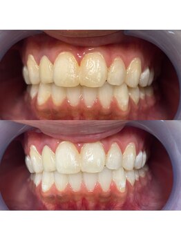 ラブホワイトニング 新宿店(LOVEホワイトニング)/高品質のホワイトニング