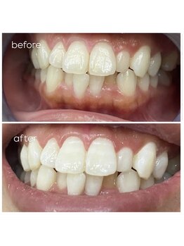 エクシアホワイトニング 津駅前店/お客様ビフォーアフター