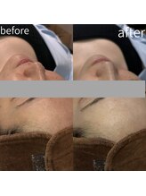 ディアー(Dear)/プラズマパールリフト