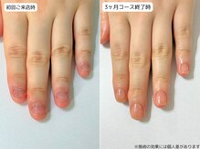 カピリナ(Ka Pilina)/自爪育成・深爪・川崎