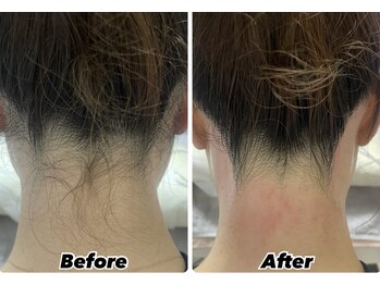 ルゼル(lezele)/うなじワックス+美容脱毛