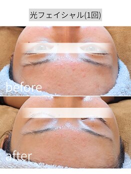 アースコアフュールボーテ ひたち野うしく店(EARTH coiffure beaute)/光フェイシャル 初回