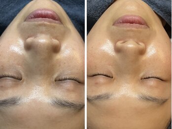 エビスラボ(Ebisu Labo)の写真/【1度で変化・違いが分かる】年齢を気にしない肌作りを♪艶肌・毛穴レス・ノンファンデーション肌