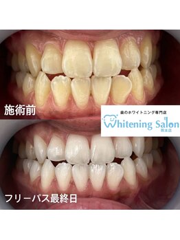 ホワイトニングサロン 熊本店/セルフホワイトニング
