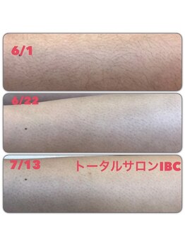 トータルサロンアイビーシー(トータルサロンIBC)/全身美肌脱毛(VIO込み)20分♪