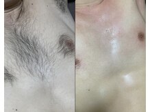 アンドエス 六本木(and S.)/ワックス＋光のW脱毛≪脱毛≫