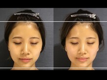 ユウキシキ(YUKISIKI)/YUKISIKI小顔矯正&美容鍼