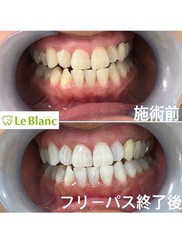 ルブラン 奈良店(Le Blanc)/白い歯って素敵!