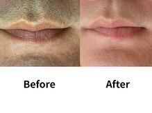 モンロー(MonroE+)/脱毛