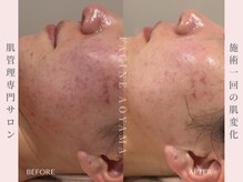 ファシネアオヤマ(FACINE AOYAMA)/VVSダイヤモンドピーリング♪