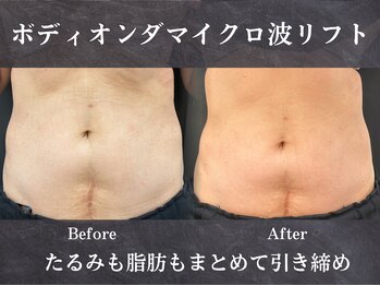 イロハ(IROHA)の写真/深部加温で脂肪にアプローチ、引き締めと巡り改善で理想のボディラインへ導きます！