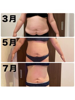 あきくに整骨院 美容整体院/T様　途中経過