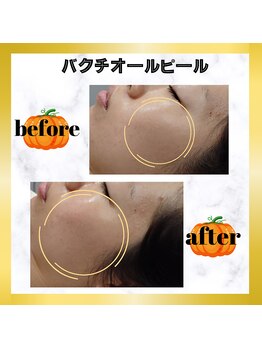 グランディールアン(GRANDIR UN)/バクチオールピール1回