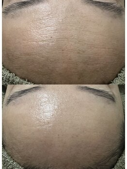 アディ(Adiy)/ビフォーアフター