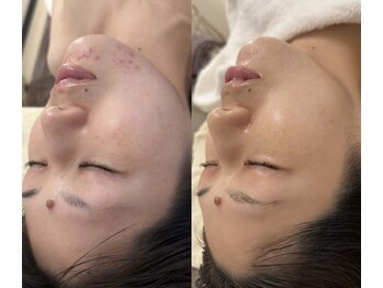 エンソワー(en'sower)/美白ケアの最終兵器！