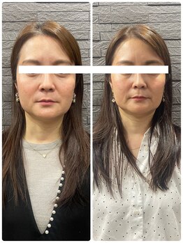 長寿鍼灸院 長寿整骨院/ハリネズミ女優美容鍼効果★