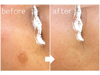 ラピュール(RaPur)/ホワイトニングケア