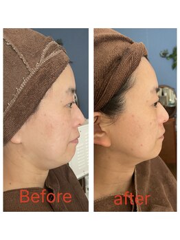 ノレーヴ(NOS REVES)/小顔ケア