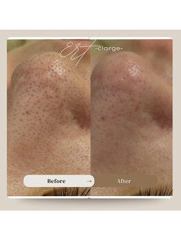 クラージュの写真/春の肌荒れが気になる季節に。毛穴の黒ずみ汚れや開きを徹底洗浄！つるんと健やかなイチゴ鼻ケア。