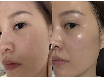 ナチュラ ソース(NatureSouce)の写真/話題の韓国くすみケアをお得に体験！毛穴を整え水光肌とツヤ感、うるおいを叶える癒やしのひと時☆