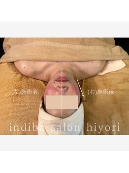 ヒヨリ(hiyori)/《before/after》フェイシャル