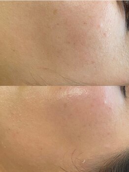 ユウビ ビューティー サロン(Yuubi)/【peel stage】ハーブピーリング