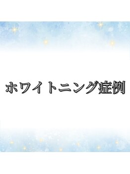 ブリリアント 京都店(Brilliant)/ホワイトニングの症例