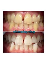 ホワイトニングショップ 大阪玉造店/Before&After美白ホワイトニング