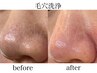 【毛穴の詰まり・ざらつき解消】毛穴洗浄＋美容液導入＋鎮静パック：7,700円