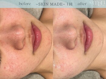 スキンラボアメリ(skin lab. ameri)/お悩み…ゆらぎ肌 赤み