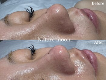 ナチュールムーン(Nature moon.)/毛穴洗浄