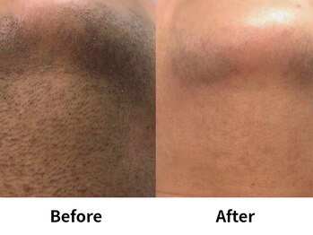 モンロー(MonroE+)/脱毛