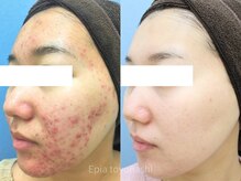 エピア 豊橋店(Epia)の雰囲気(繰り返す頑固な大人ニキビケアはお任せください◎)