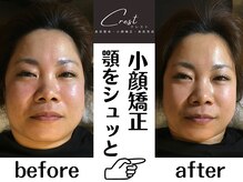 クレスト(CREST)の雰囲気（40代女性→ほうれい線.顔のたるみのお悩みの看護師の女性！）
