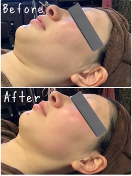 エステティックジュネス(JEUNESSE)/中顔面短縮