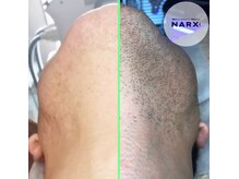 ナークス(NARX)/たった1回でもここまで変わる♪