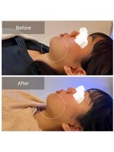 ウィズ ユー ビューティ(with U beauty)/フェイスラインくっきり