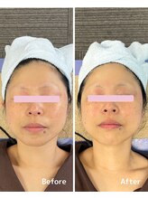 おおむら鍼灸接骨院/フェイシャル Before＆After