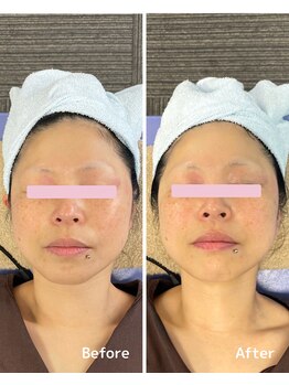 おおむら鍼灸接骨院/フェイシャル Before＆After