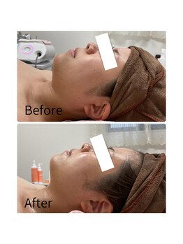 ナタリー(Natalie)/インディバフェイシャル