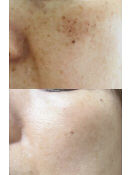 アレイズ(ARAYS)/症例