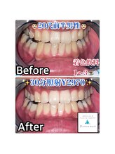 ホワイトニングビューティー 吉祥寺店/症例写真_初来店されたお客様