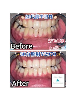 ホワイトニングビューティー 吉祥寺店/症例写真_初来店されたお客様