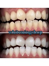 ホワイトニングショップ 三田店/before after