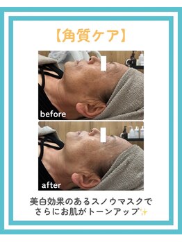 トッコ 清澄白河店(tocco)/BBL角質ケア